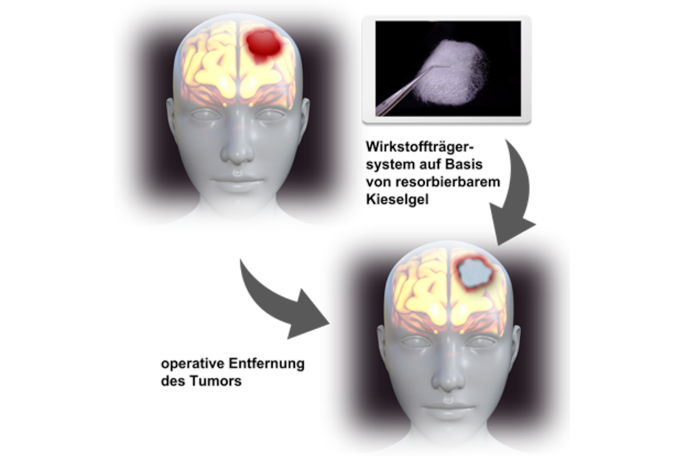 Lokale postoperative Chemotherapie von Glioblastomen mit einem auf Kieselgel basierten Wirkstofffreisetzungssystem