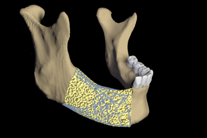 Symbolbild: Implantatstruktur im Kieferbereich